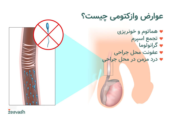 برخی عوارض وازکتومی عبارتند از درد، خونریزی و تجمع اسپرم.